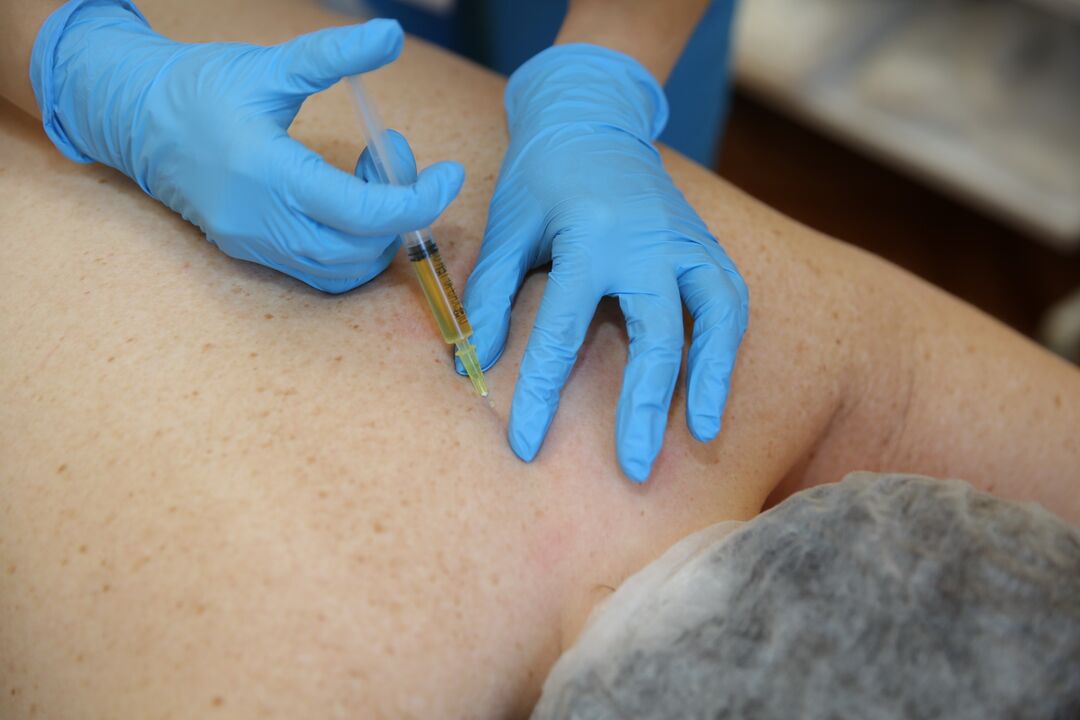 inyecciones de condroprotectores para la espalda