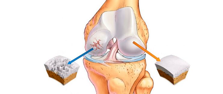 Artrosis deformante de la articulación de la rodilla (izquierda) y de una articulación sana (derecha)