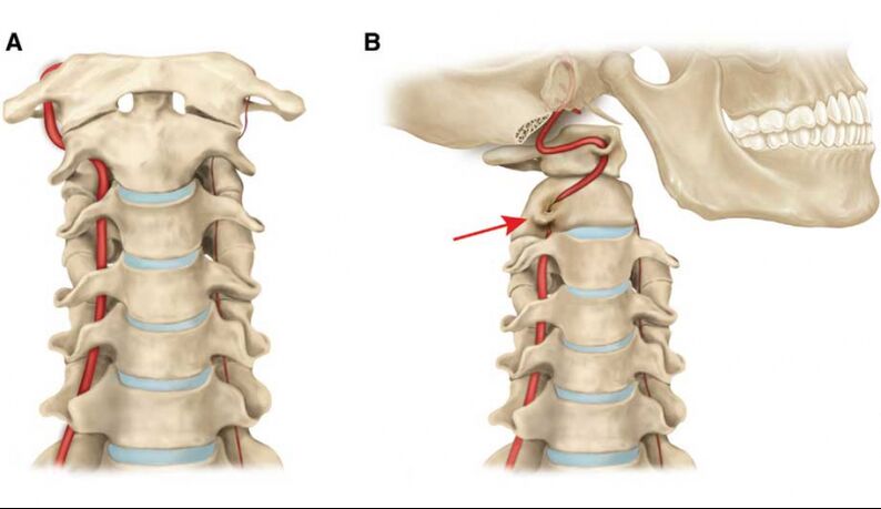 Curso de la arteria vertebral.
