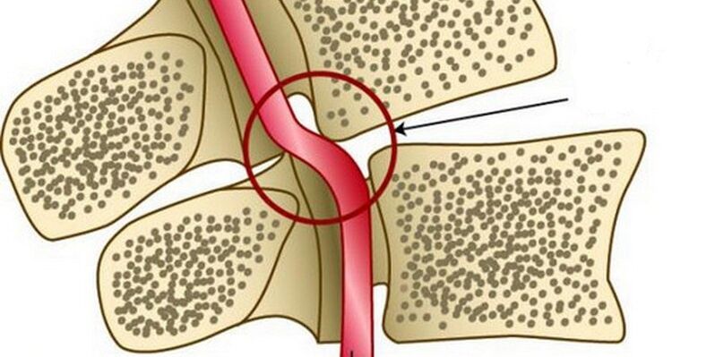 Deformación de la arteria vertebral debido a la inestabilidad vertebral.